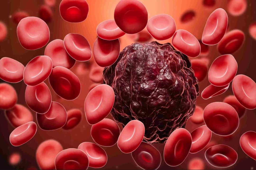 Treatment of Blood Cancer : एमवाय अस्पताल में होगा इम्यूनोथेरेपी से ब्लड कैंसर का इलाज, 20 लाख में पूरी हो सकेगी ये थेरेपी