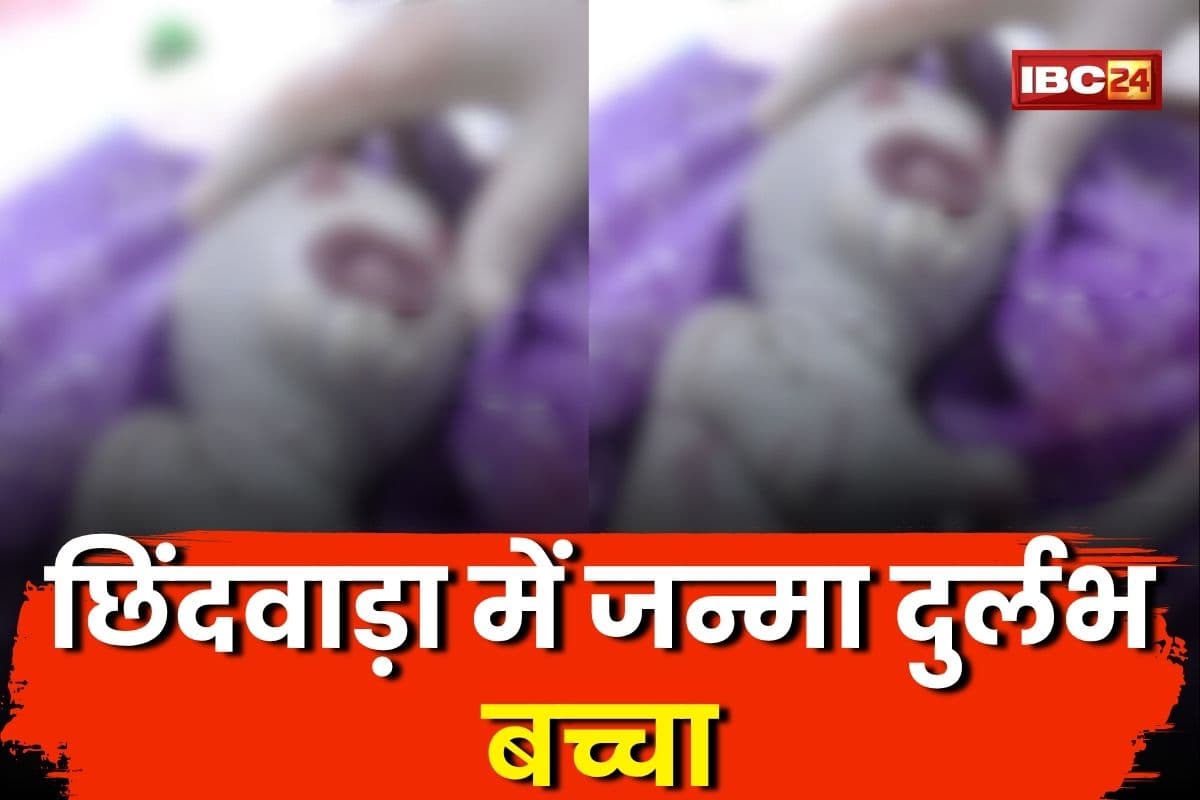 Chhindwara News: आंख, कान, नाक सब गायब, छिंदवाड़ा में जन्मा दुर्लभ बच्चा, देखकर डॉक्टर भी रह गया हैरान