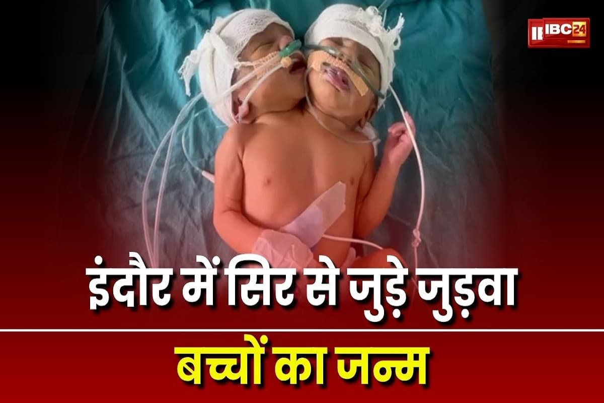 Indore News: एक जिस्म दो जान! इंदौर में दो सिर वाले जुड़वा बच्ची का हुआ जन्म, देखकर डॉक्टर भी रह गए हैरान