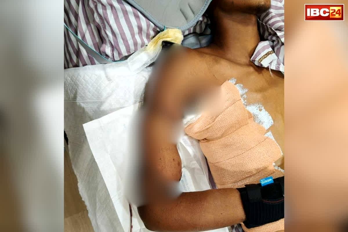 Shri Narayana Hospital Raipur News: श्री नारायणा हॉस्पिटल की टीम ने कर दिखाया असंभव को संभव..! हड्डी बाहर, नसें डैमेज फिर भी बचाया शरीर का अहम हिस्सा, युवक को मिली नई जिंदगी