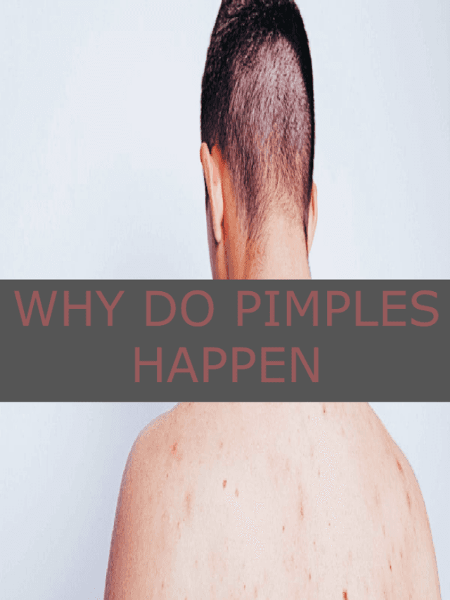 PIMPLES: जानें आखिर किस कारण होते हैं चेहरे और बॉडी पर पिंपल