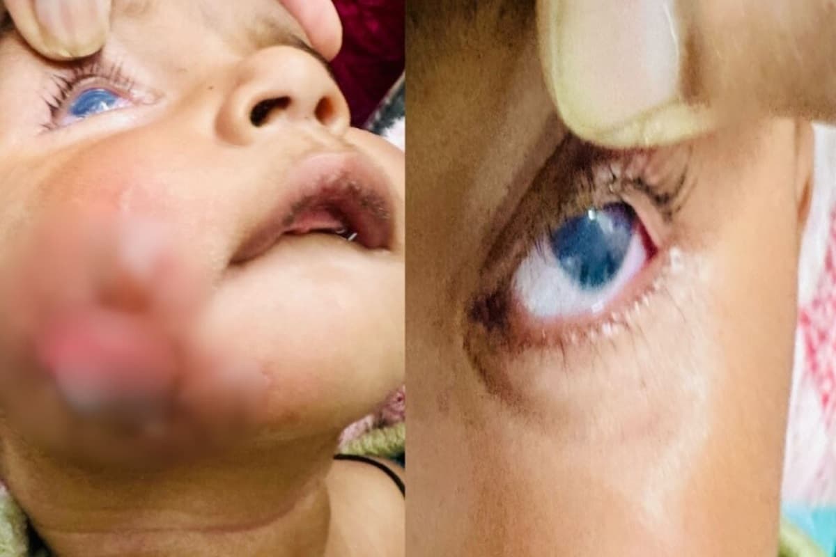 Shivpuri News: अंधविश्वास की आड़ में 6 माह के मासूम की जान से खिलवाड़.. आग पर उल्टा लटकाया, चेहरा जला, दोनों आंखें भी झुलसी, फिर..
