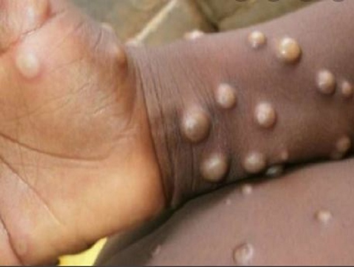 Monkeypox: 29 देशों में 1000 से अधिक मामले, हवा के जरिए फैल रहा वायरस, WHO ने दी चेतावनी