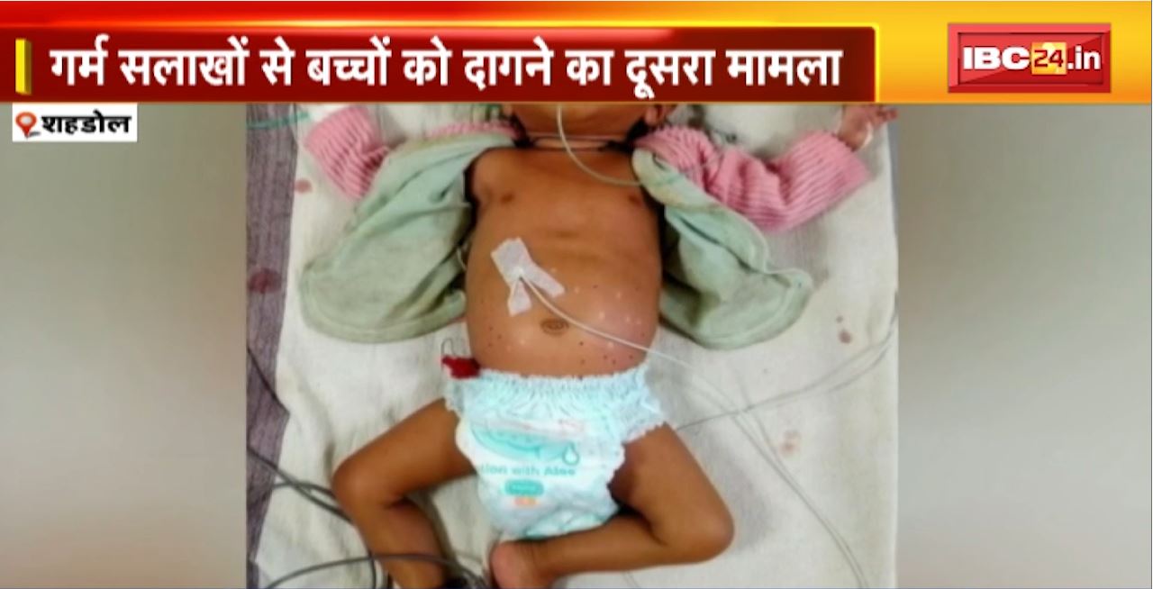 Shahdol News : अंधविश्वास के कारण मासूम की हुई मौत, महिला ने बच्चे के शरीर पर दागी गर्म चूड़ियां, अस्पताल में इलाज के दौरान तोड़ा दम..