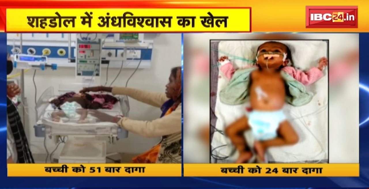 Shahdol Crime News : गर्म सलाखों से दागने की तीसरी घटना आई सामने। 20 दिन के बच्चे को गर्म सलाखों से दागा