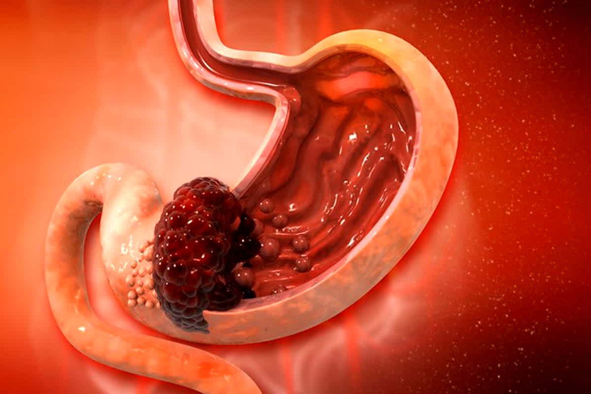 Gastric Cancer Symptoms: 60 साल की उम्र के बाद बढ़ सकता है इस खतरनाक बीमारी का खतरा, जानिए इससे लक्षण