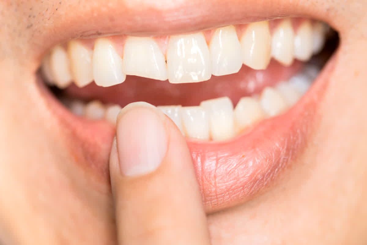 Teeth Whitening Tips: दांतों के पीलेपन से होती है शर्मिंदगी महसूस, आज ही करें ये उपाय, चमकने लगेंगे आपके दांत