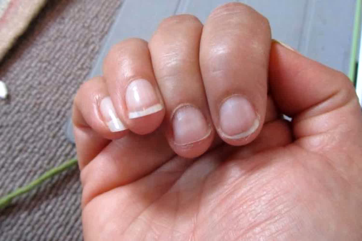 Health Tips: उंगलियों के नाखून बार-बार टूटना इन बीमारियों का देती है संकेत, जानिए कैसे पहचानें