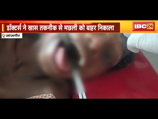 Janjgir News : बच्चे के मुंह में फंसी मछली | Doctors ने खास तकनीक से मछली को निकाला बाहर | देखिए